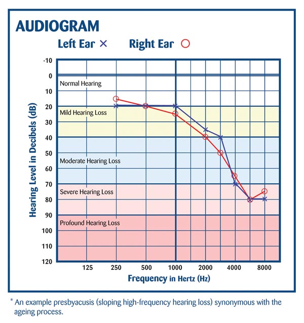 Sample Audiogram